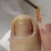 Причини виникнення нариву на пальці біля нігтя: як лікувати медикаментами і народними методами